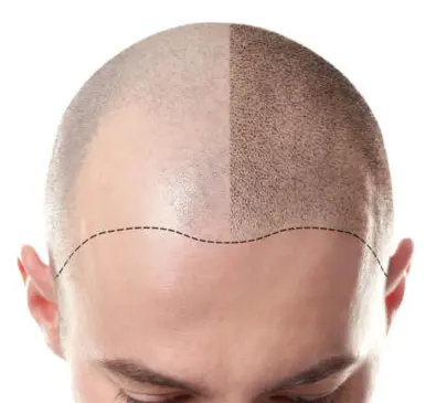 Micropigmentación Capilar antes y despues